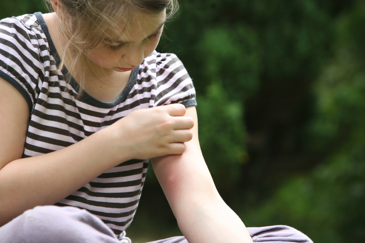 how-to-stop-black-fly-bites-from-itching-greenmoxie